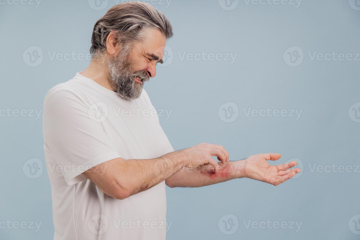 Senior man scratching itchy eczema on arm suffering from dermatitis photo