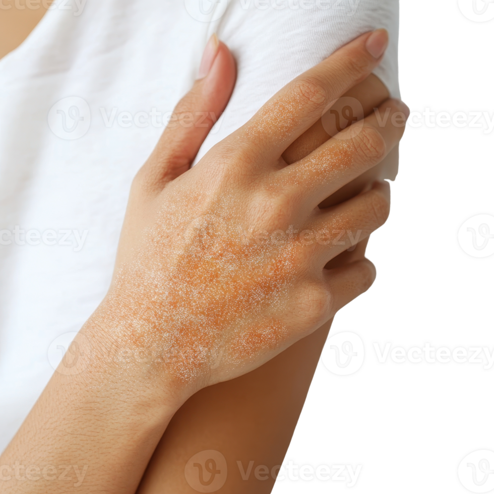A close-up of a hand with skin irritation, possibly a rash, against a neutral background, highlighting the texture and condition of the skin. png