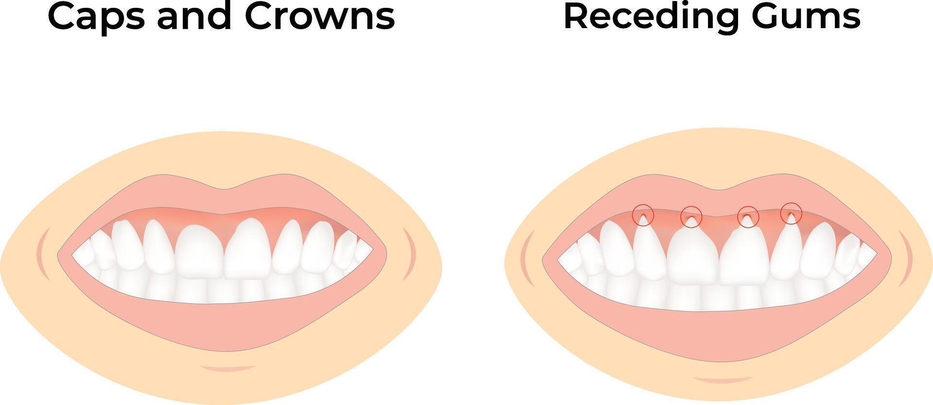 Caps Crowns and Receding Gums Design Illustration vector