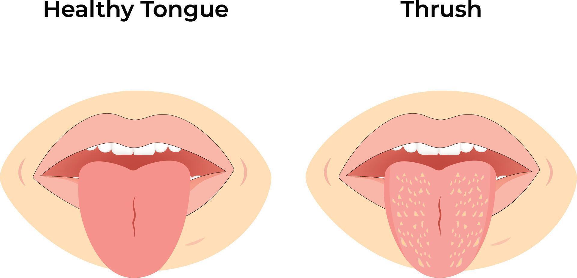 Healthy Tongue vs Thrush Design Illustration vector