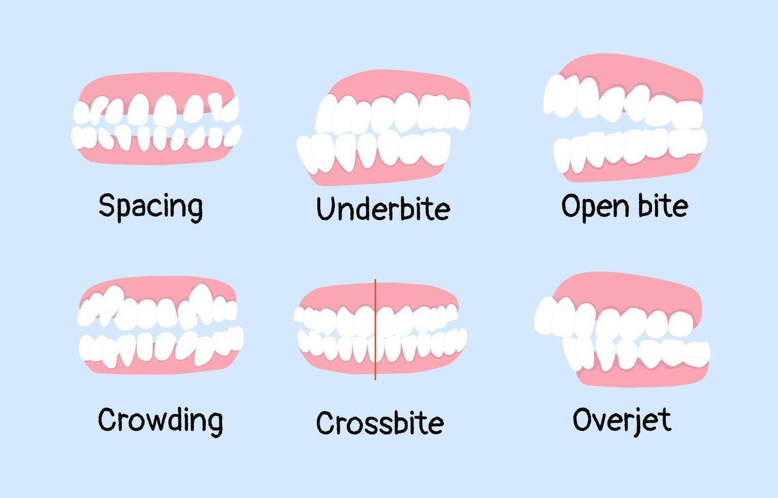 spacing, underbite, open bite, crowding, crossbite, overjet list of orthodontic dental problem vector