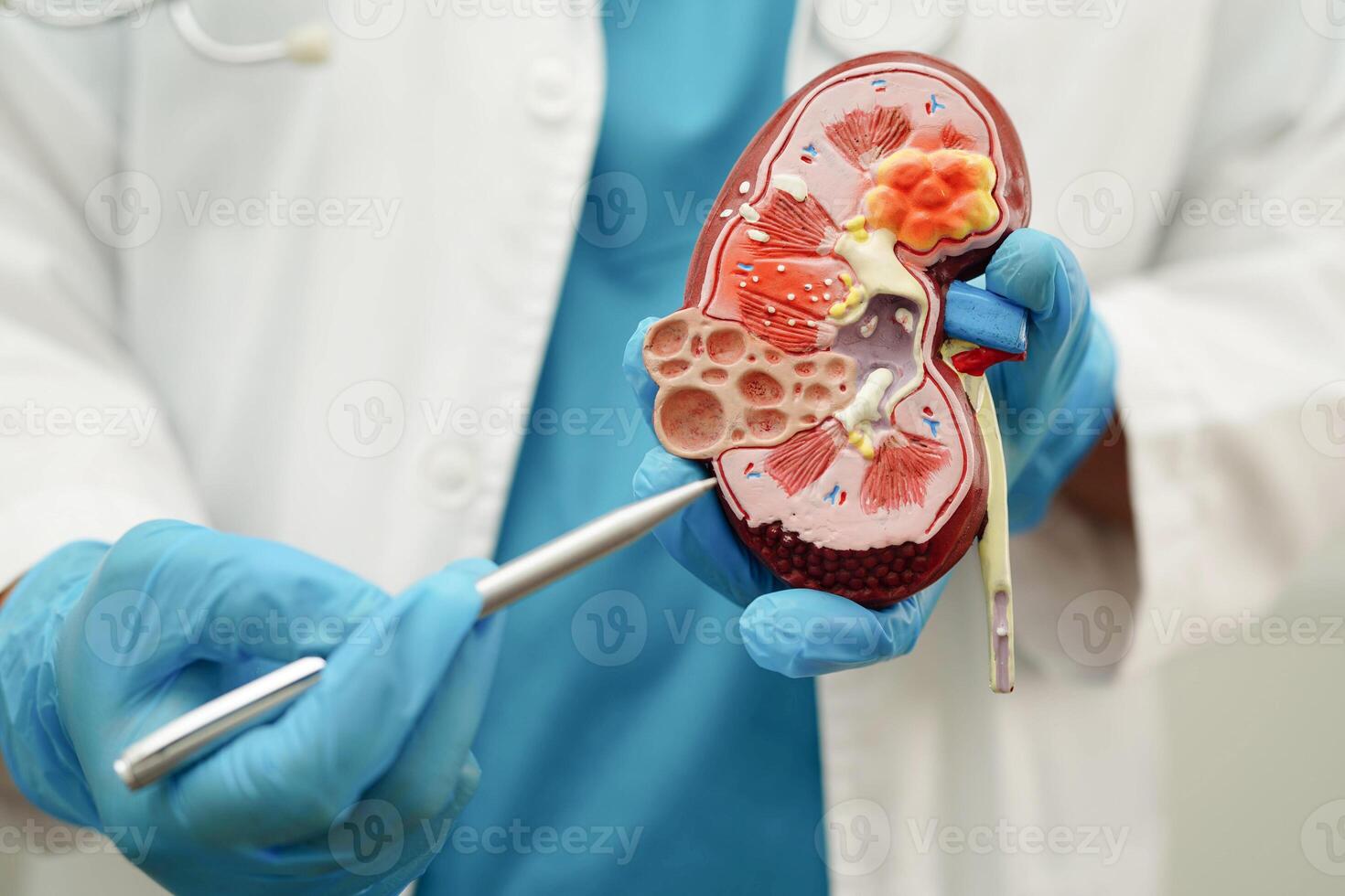 Chronic kidney disease, doctor with model for treatment urinary system, urology, Estimated glomerular filtration photo