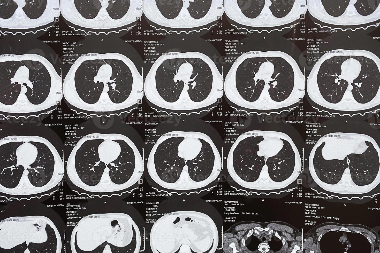 Computed tomography of the lungs. Chest CT scan with signs of bronchiolitis photo