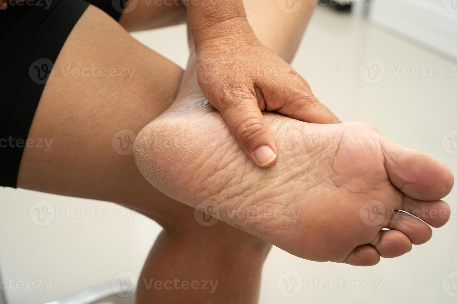 Asian woman care feet with cracked and dry heel photo