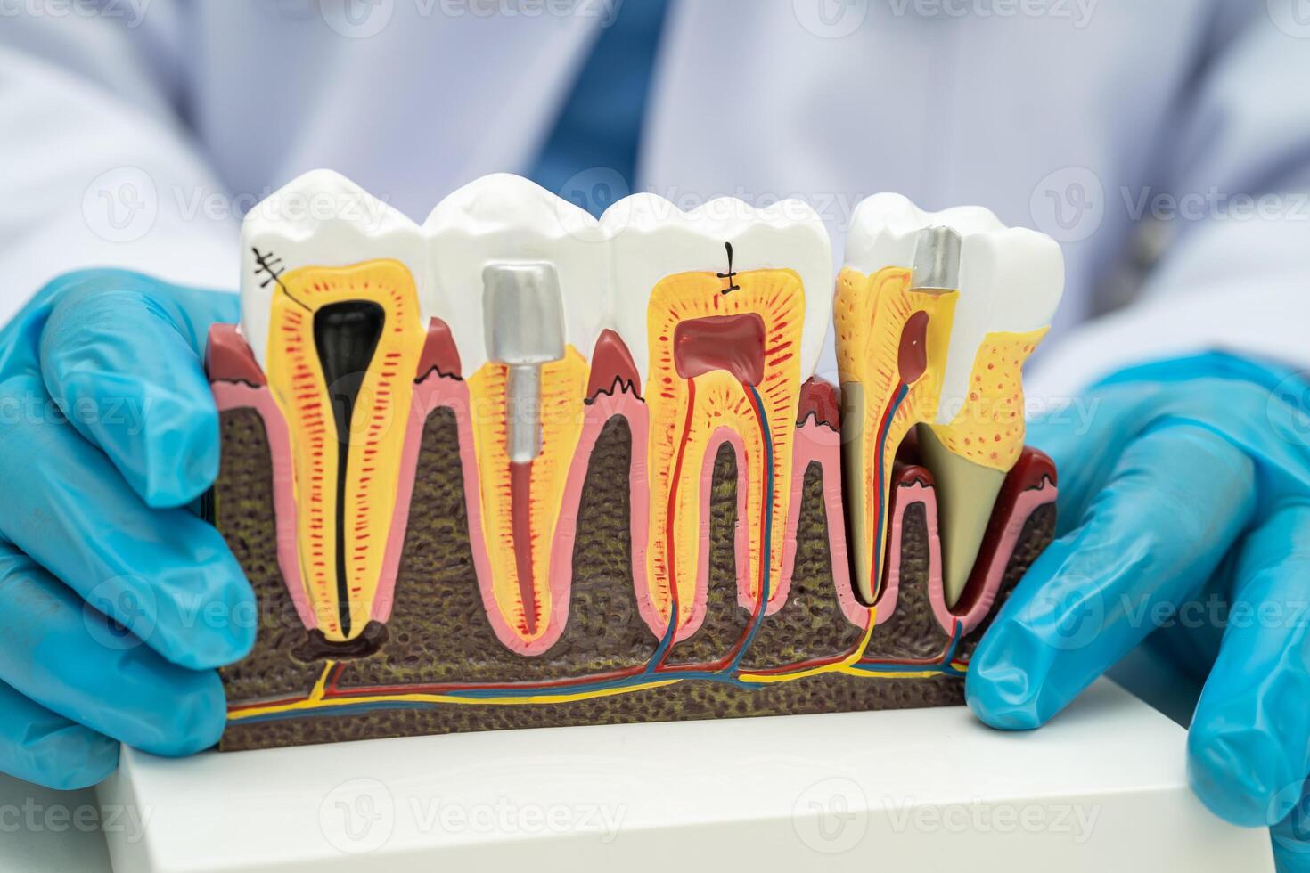 Asian dentist holding dental implant, artificial tooth roots into jaw, root canal of dental treatment, gum disease, teeth model photo