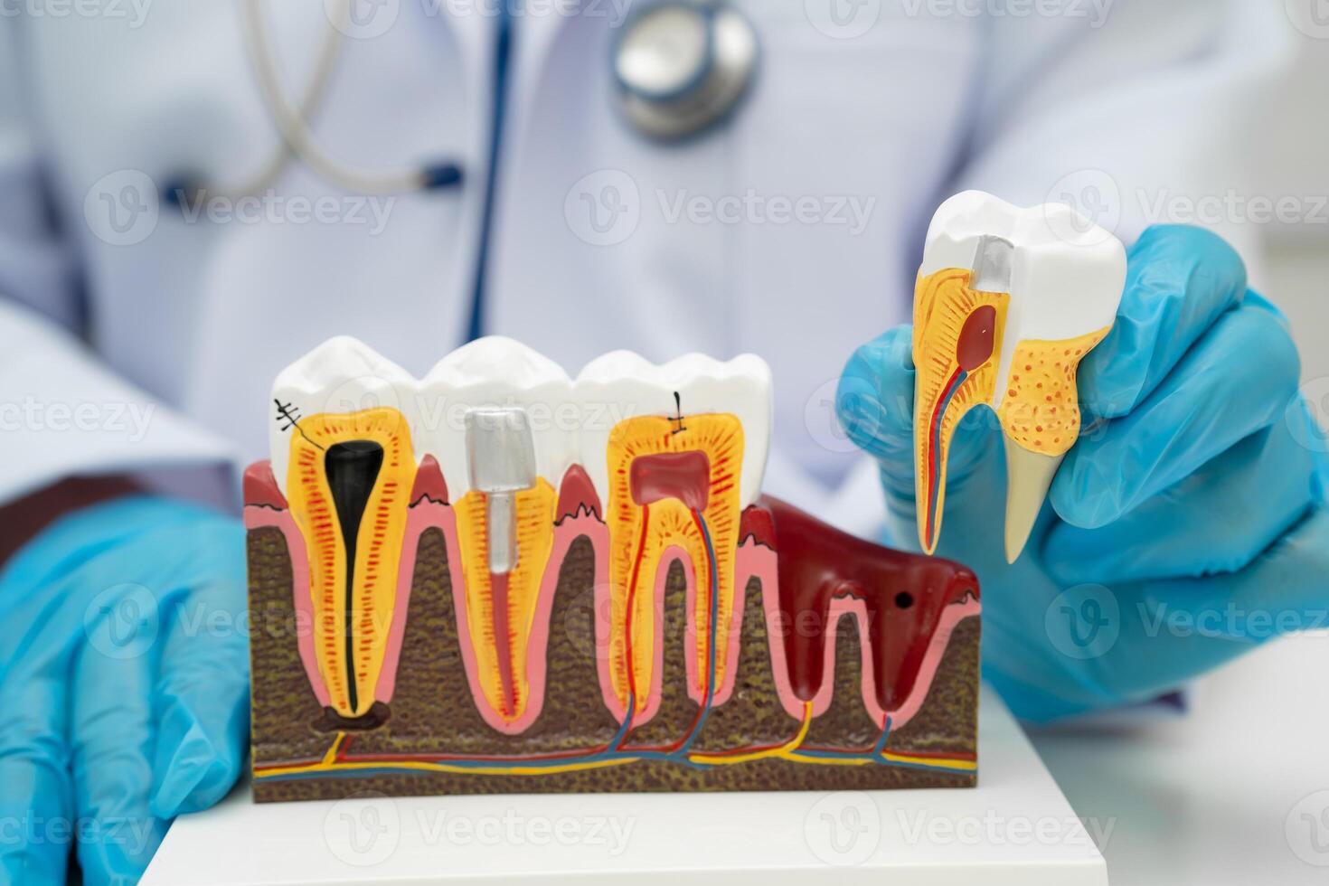 Asian dentist holding dental implant, artificial tooth roots into jaw, root canal of dental treatment, gum disease, photo