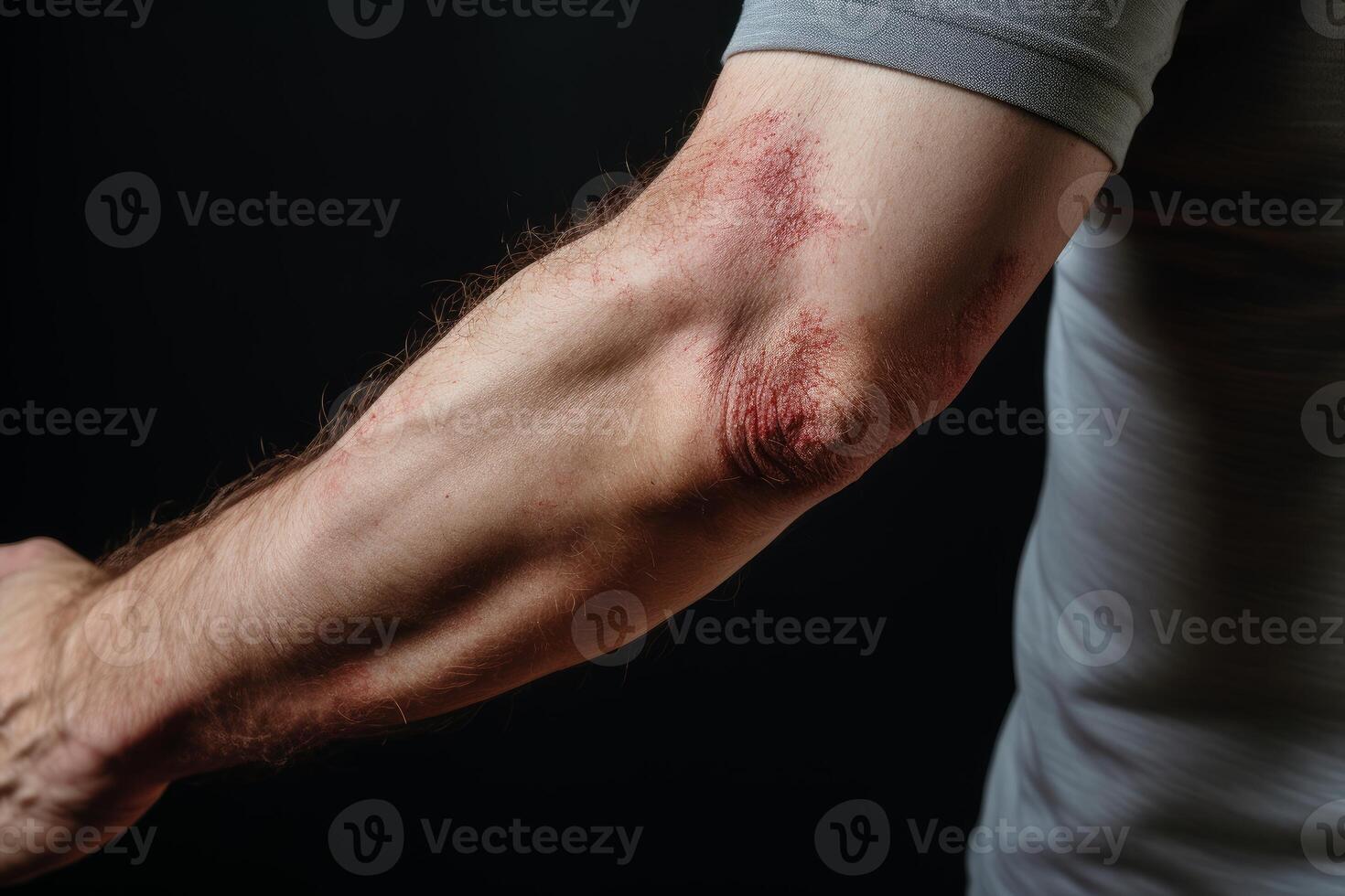 Man showing severe eczema rash on arm and elbow photo