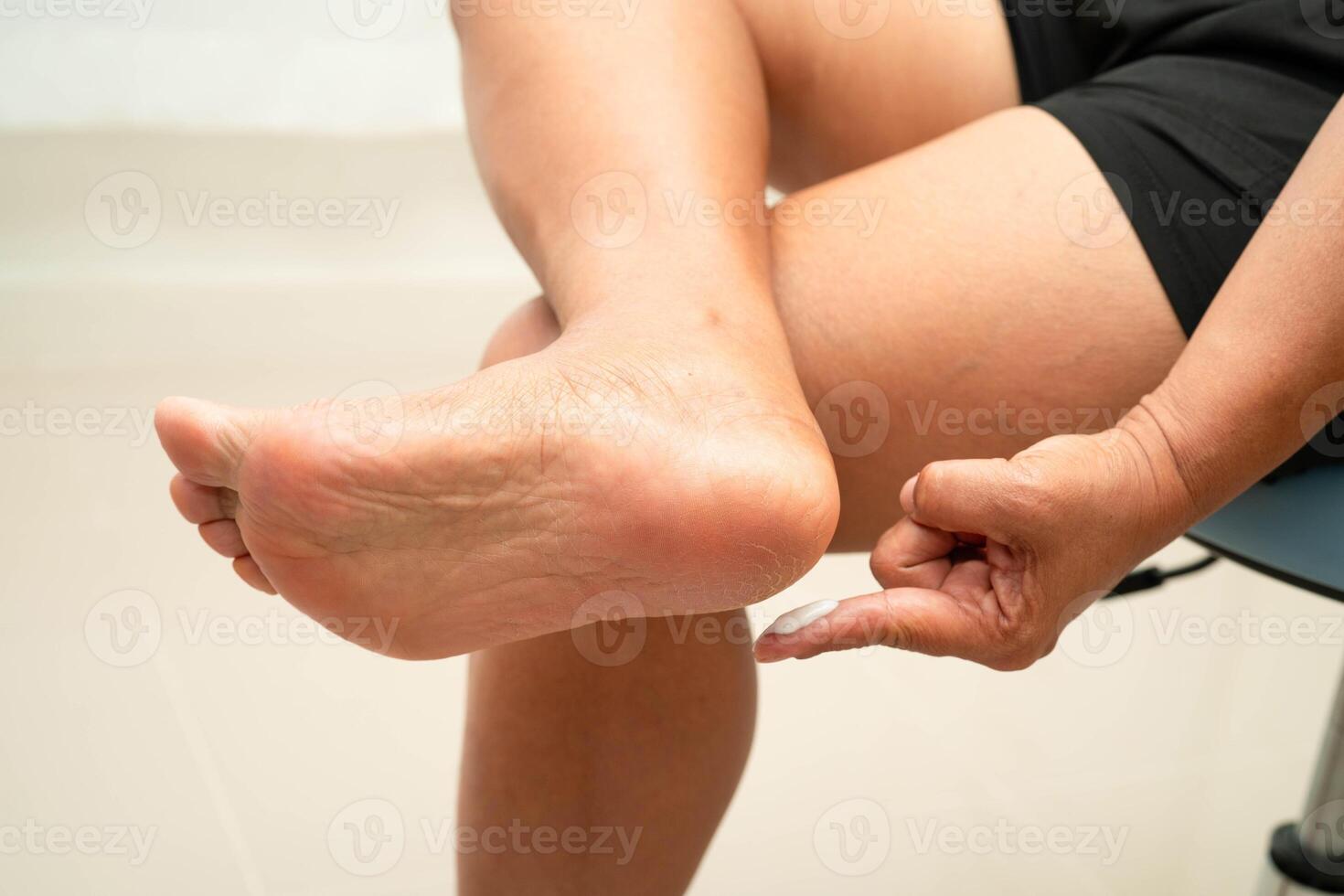 Asian woman applying moisturizing cream skincare treatment to solve and repair feet with crack and dry photo