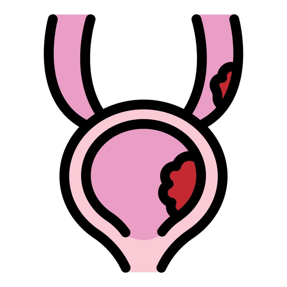 Bladder showing cancer cells growing and spreading through urinary system vector