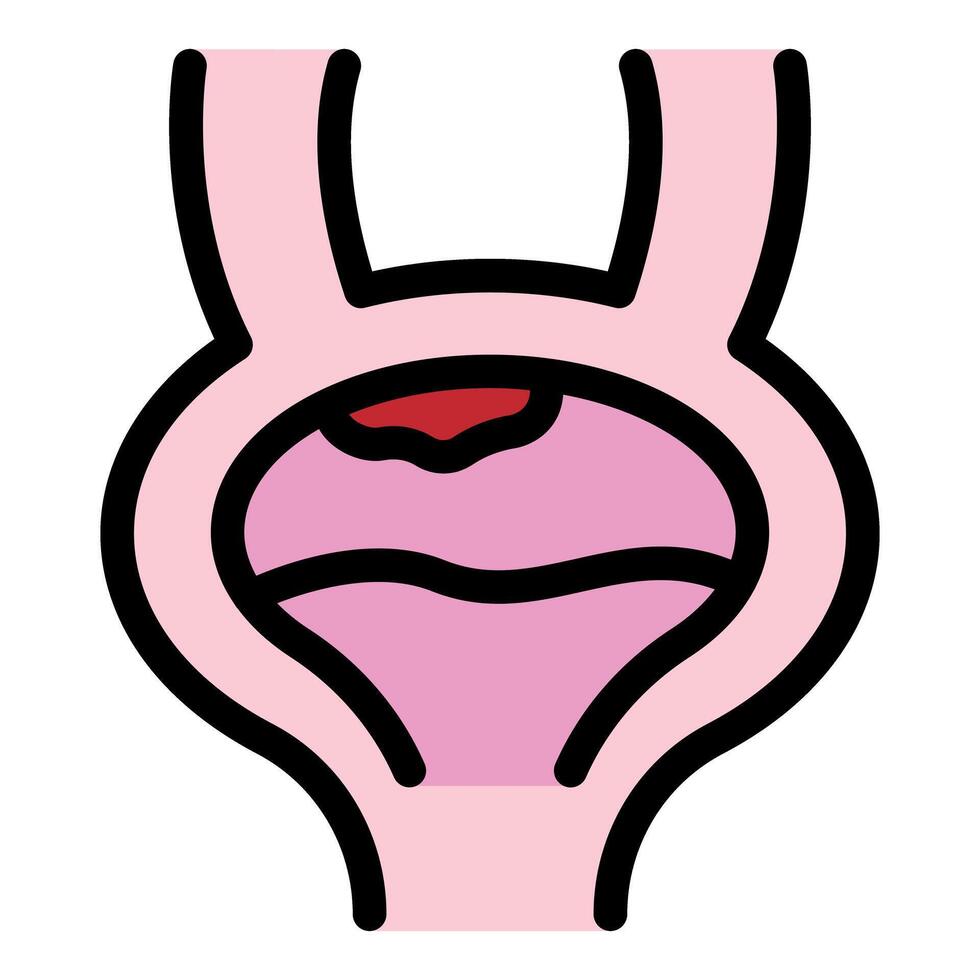 Bladder polyp showing cancerous cells growing and multiplying vector