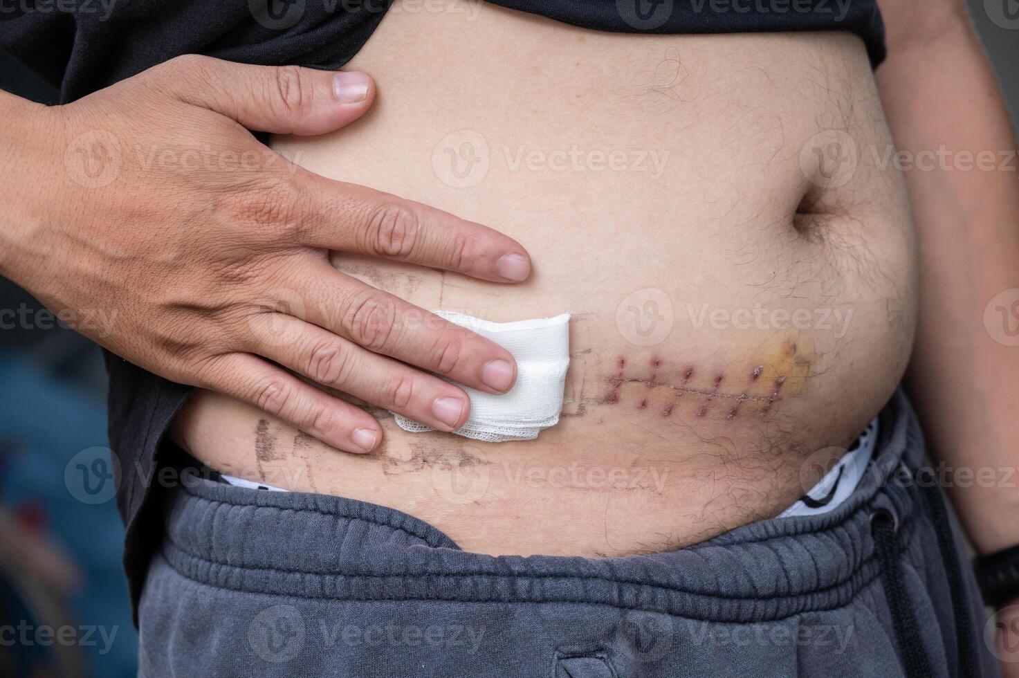 Cropped shot view of patient touching his belly after Appendectomy surgery. photo