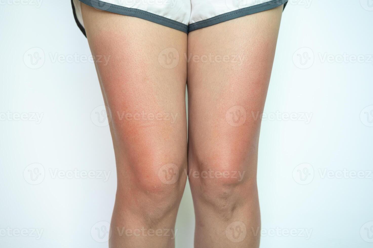 Cropped shot view of woman having sunburn damaged on her thigh. Sunburn is red, painful, damaged skin from being out in the sun for too long. photo
