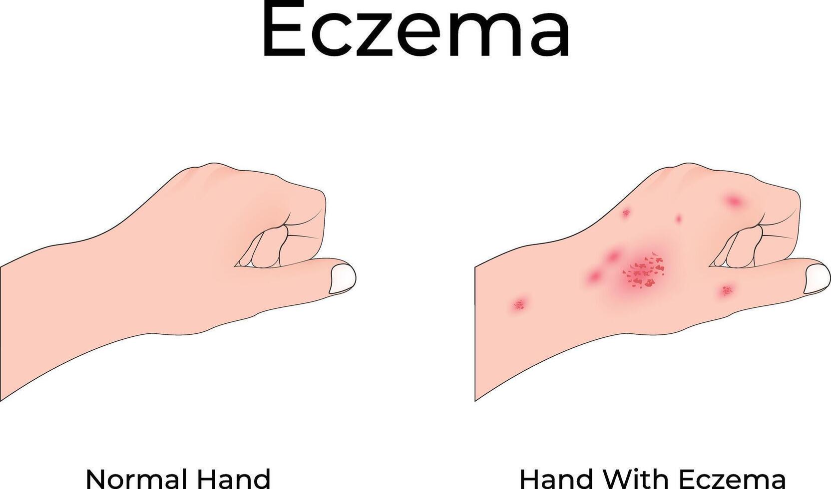 Eczema on Hand Design Colorful Illustration vector