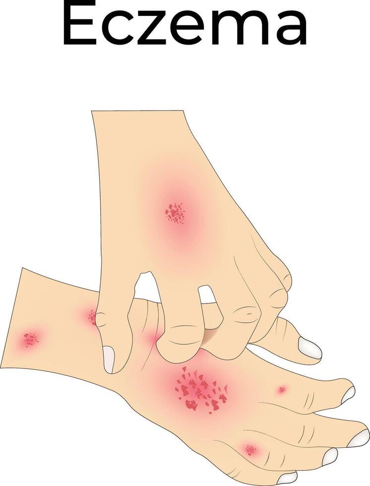 Eczema and Hand Design Illustration vector