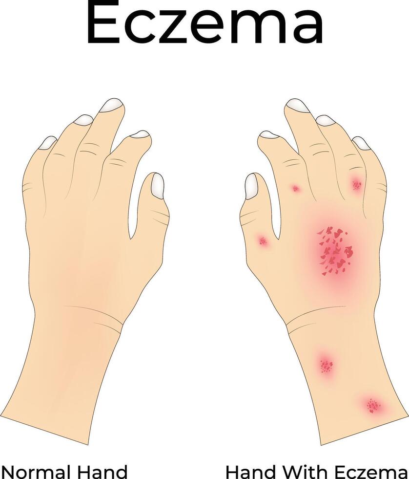 Eczema on Hand Illustration vector