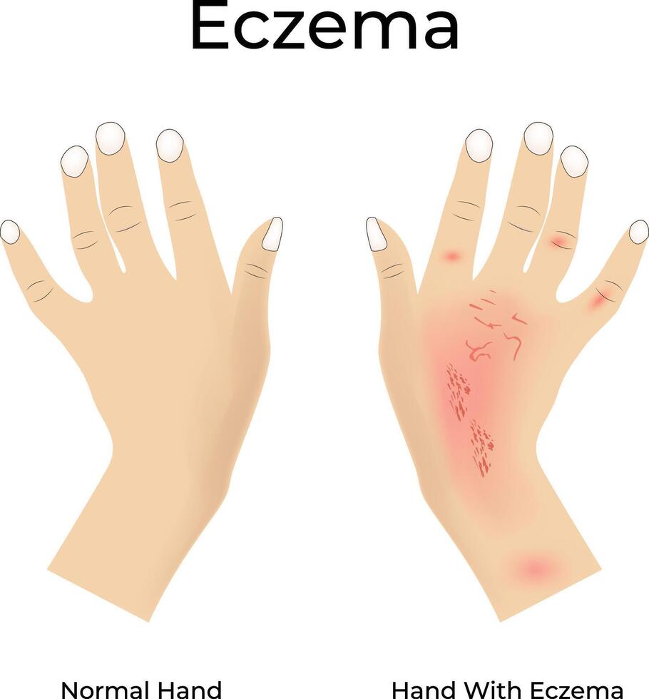 Eczema on Hand Design Illustration vector