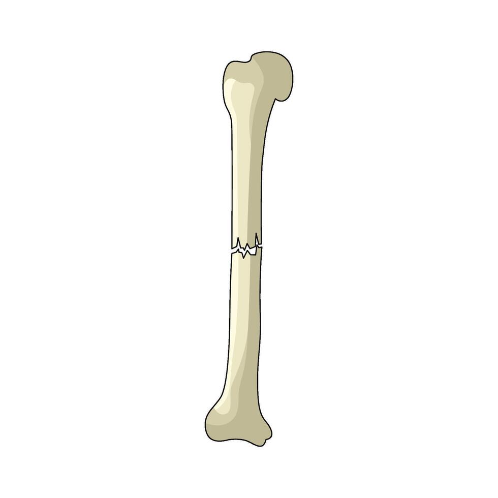 illustration of Bone Fracture vector