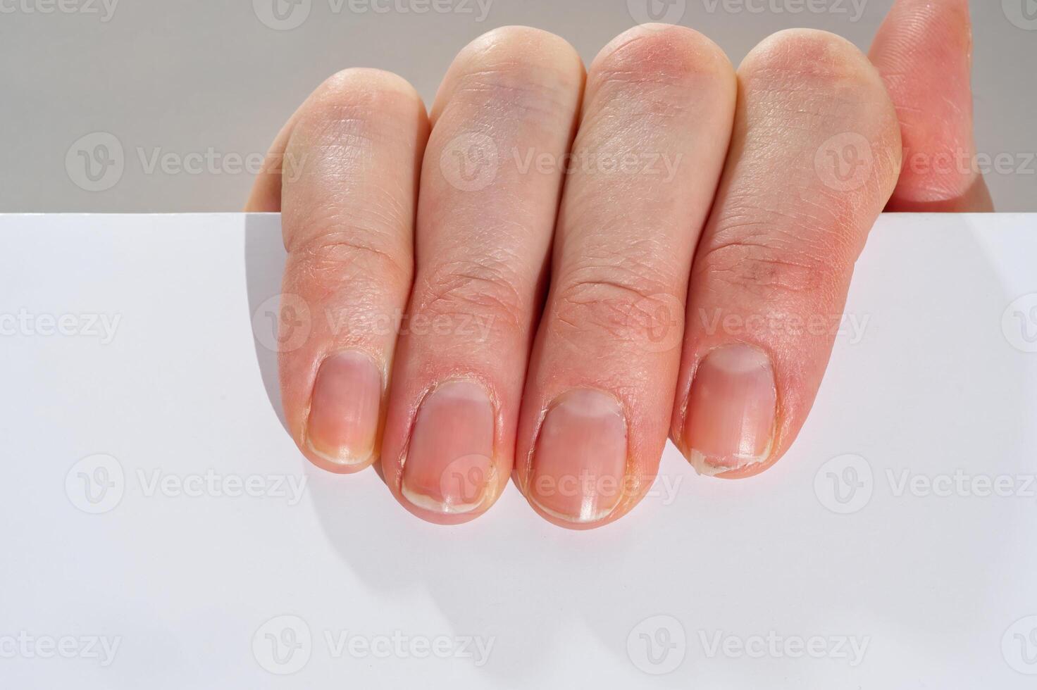 Close-up of brittle nails on woman's hands. Female broken fingernail. weak sore nails. photo