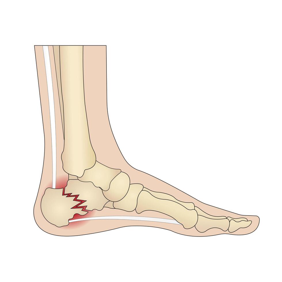 Calcaneus fracture. Foot injury vector