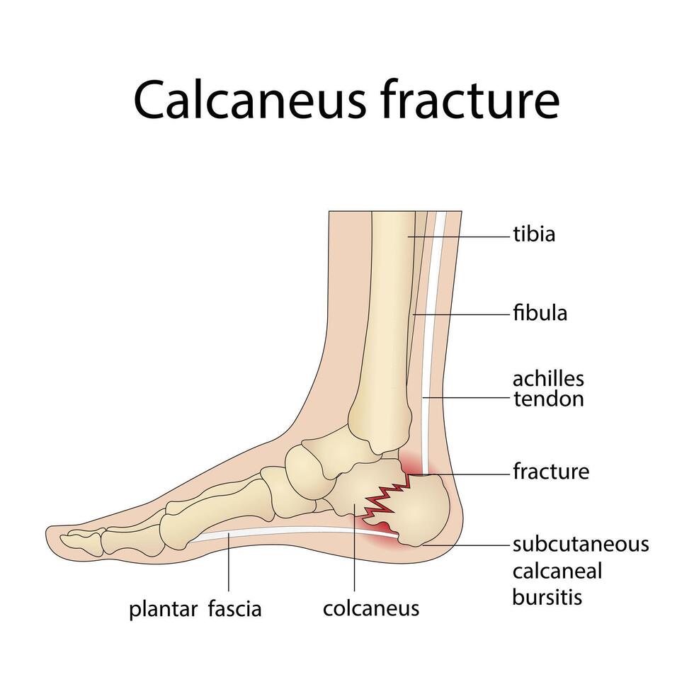 Anatomy of a calcaneal fracture with a diagram of the structure vector