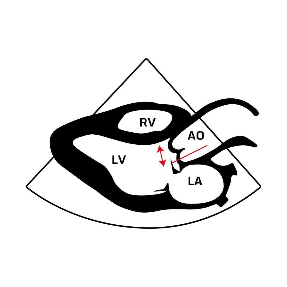 ejection fraction, heart human disease vector