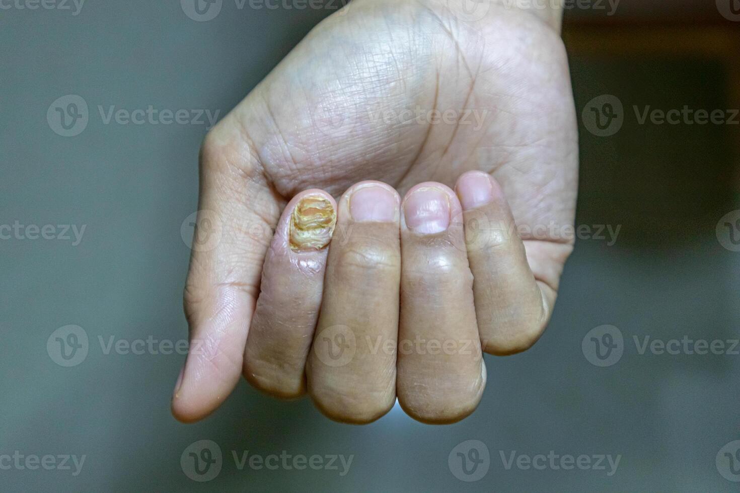 Index finger nail infected with fungus photo