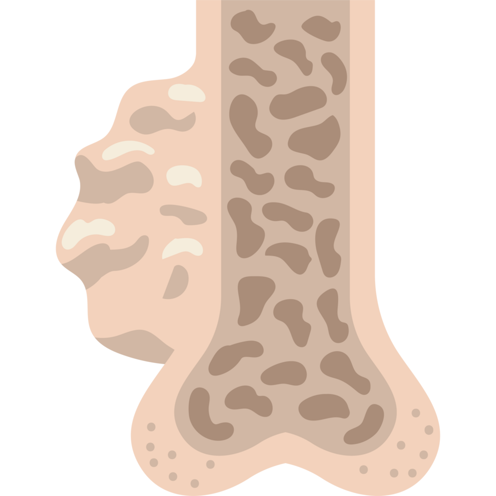 multiple myeloma cross section of bones png