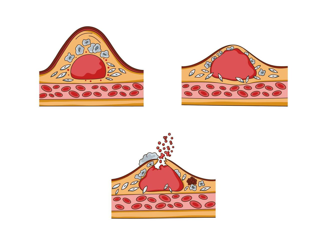 Cholesterol plaque structure and thrombus formation medical educational science illustration. Vascular anatomy vector