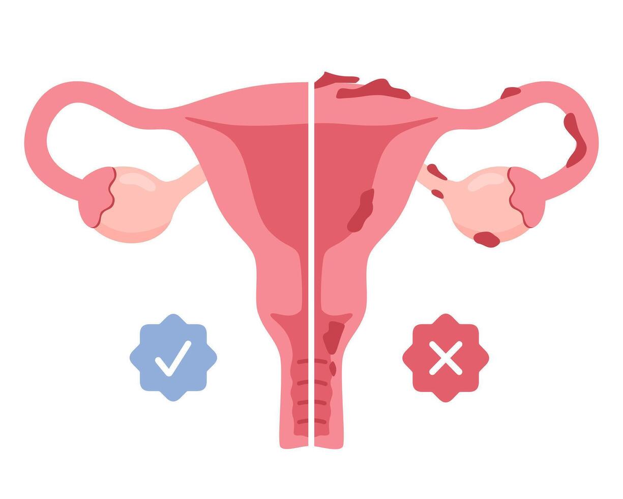 Uterus with endometriosis infographic in flat style. vector
