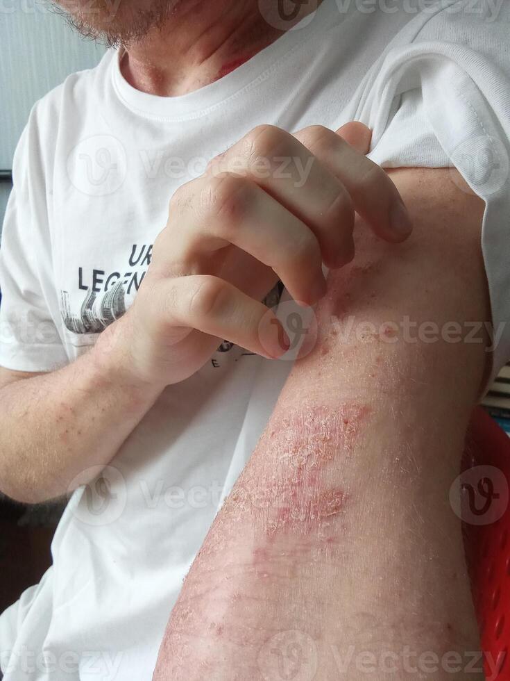 irritated skin because the skin is sensitive to certain conditions photo