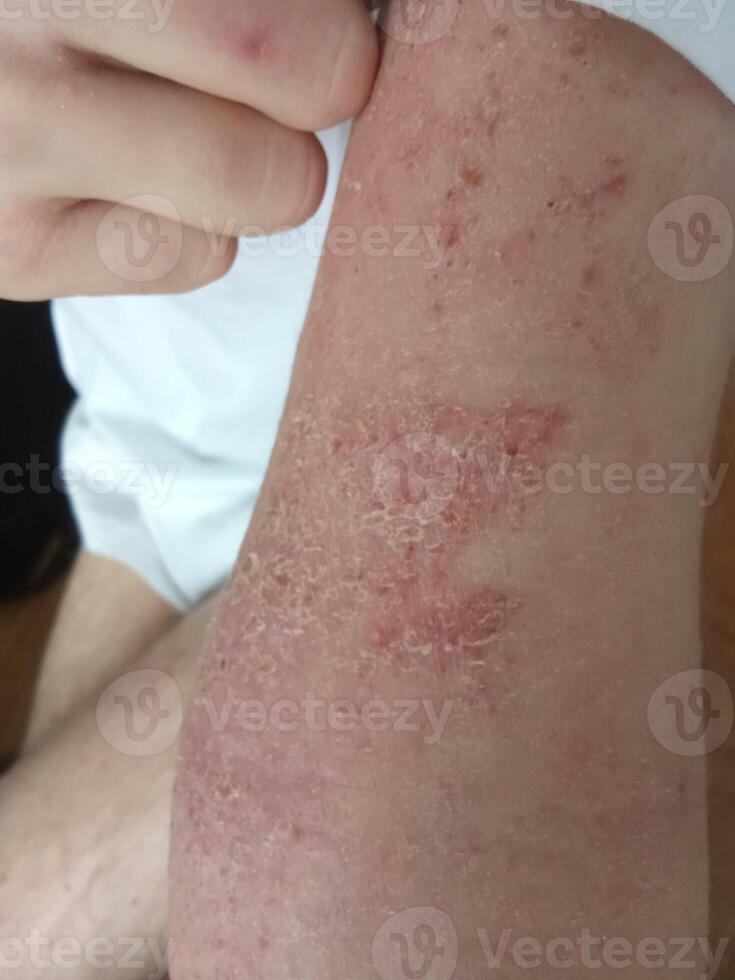 Close up on eczema, rash, atopic dermatitis, inflamed skin photo
