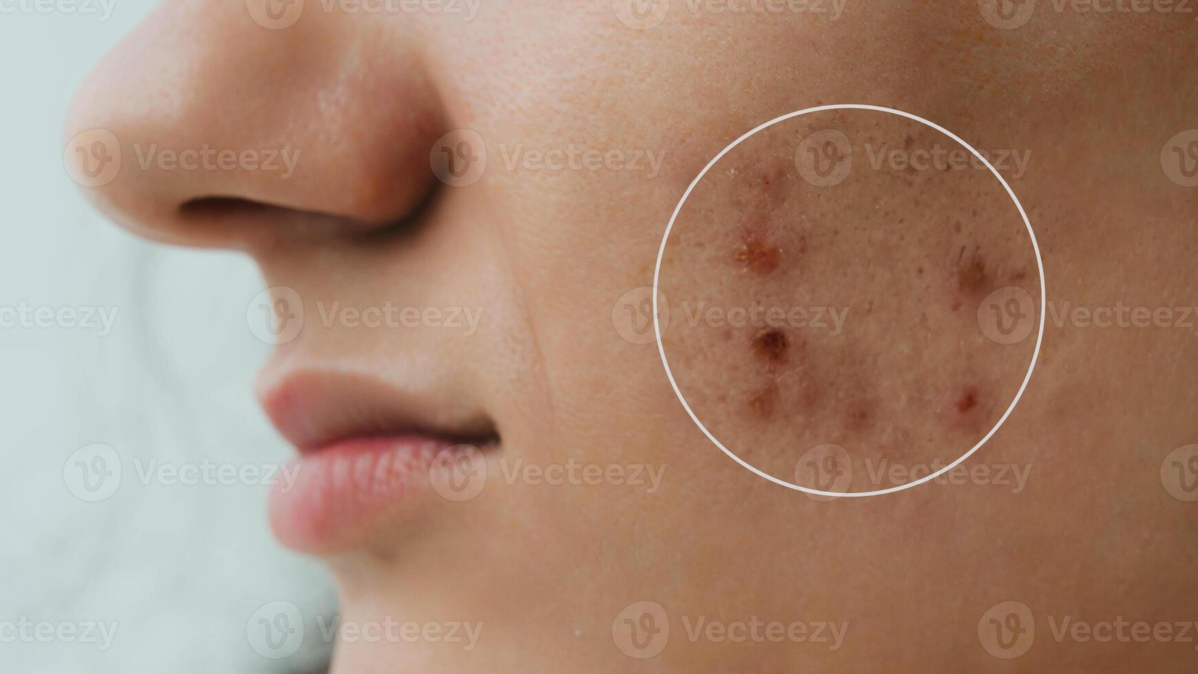 Close-up of a young girl with skin problems. Pimples, acne, pores, scars. Natural skin with and without filters. photo