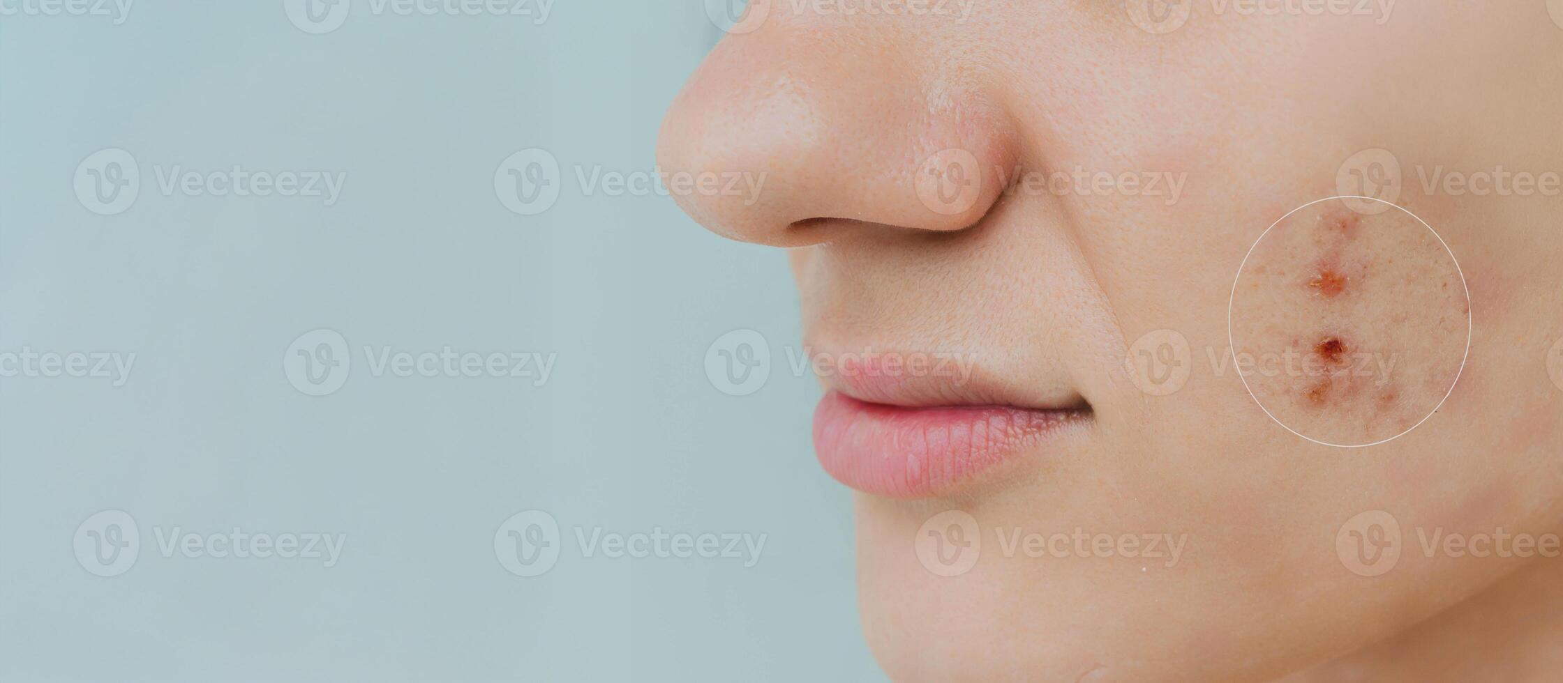 Close-up of a young girl with skin problems. Pimples, acne, pores, scars. Natural skin with and without filters. A place for your text. photo
