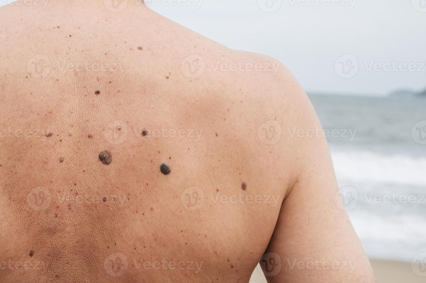 The back of an elderly man with freckles, aging spots, black, brown warts and wrinkles against the background of the sea photo