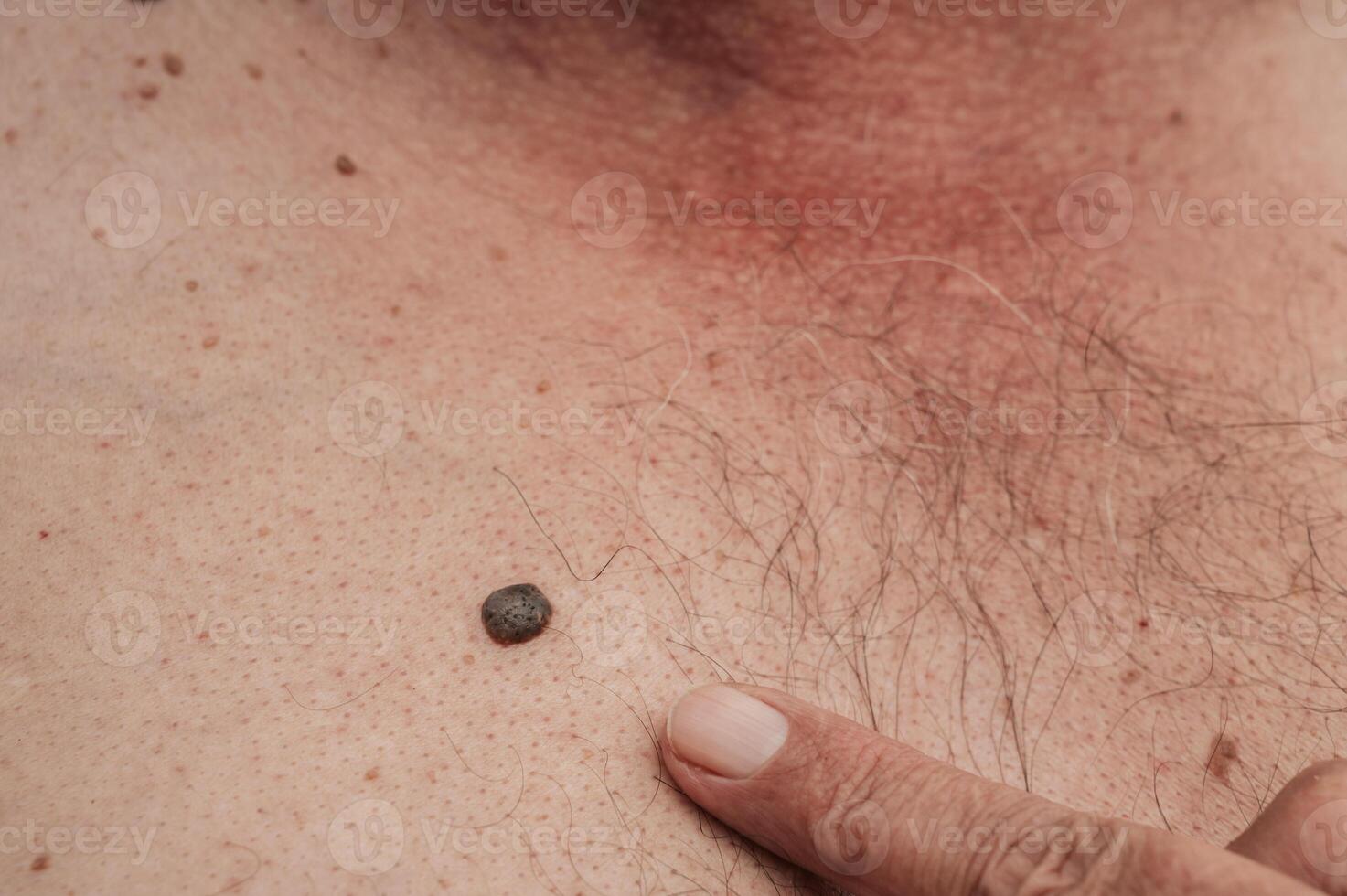 keratinizing squamous cell carcinoma of the skin of an elderly man photo