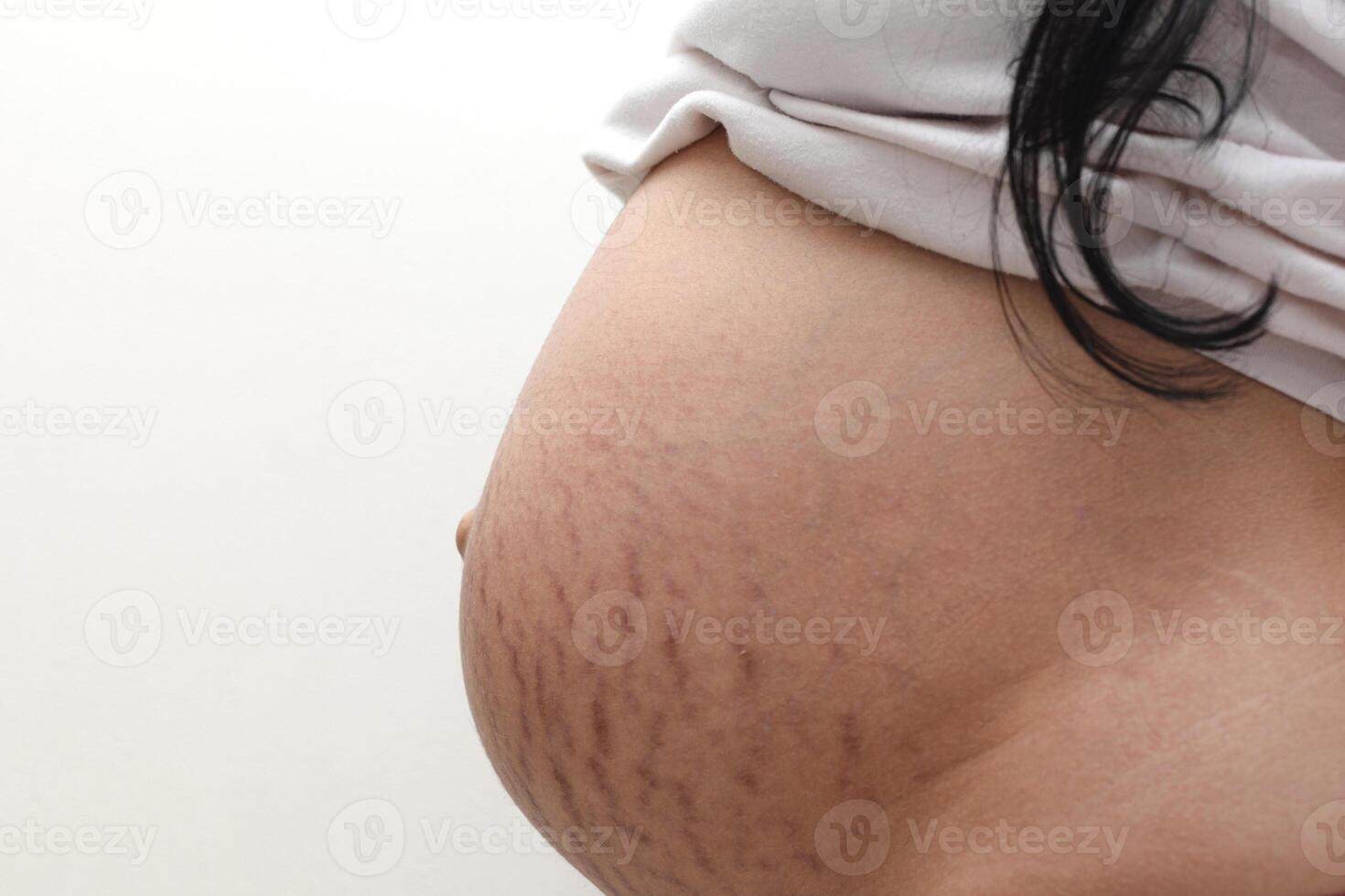 stretch marks on belly photo