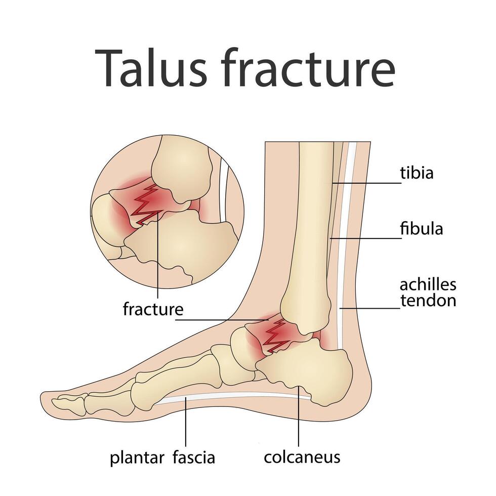 Illustration of bone fractures. Anatomical structure of the human foot with a painful par vector