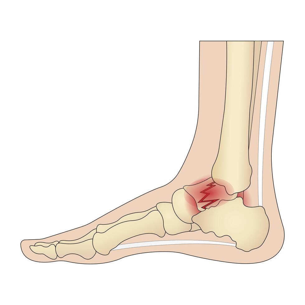 Anatomical structure of the human foot with a painful part vector