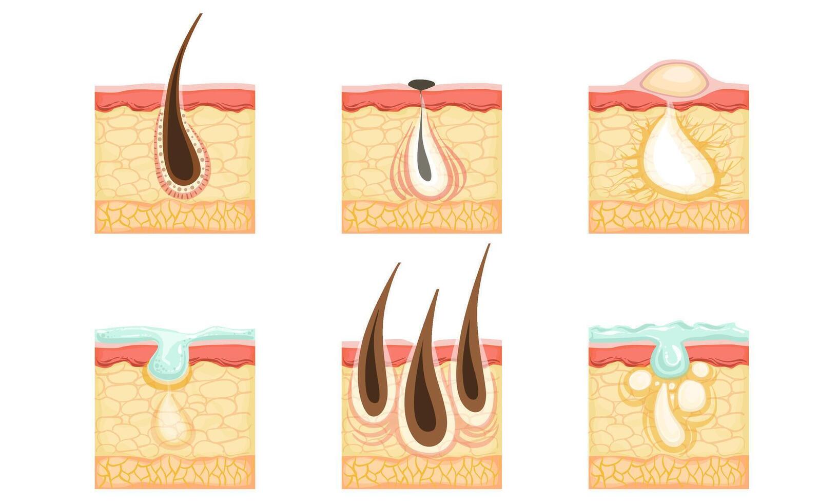 Set of skin images with hair roots, acne and sweat. illustration. vector
