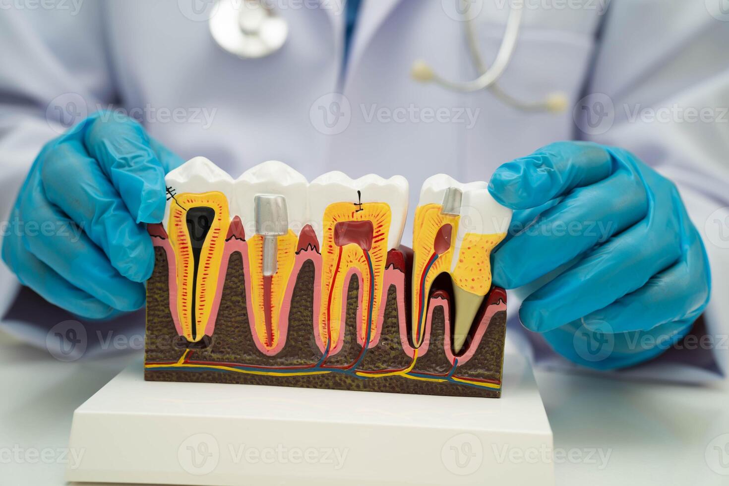 Dentist holding dental implant, artificial tooth roots into jaw, root canal of dental treatment, gum disease, teeth model for photo