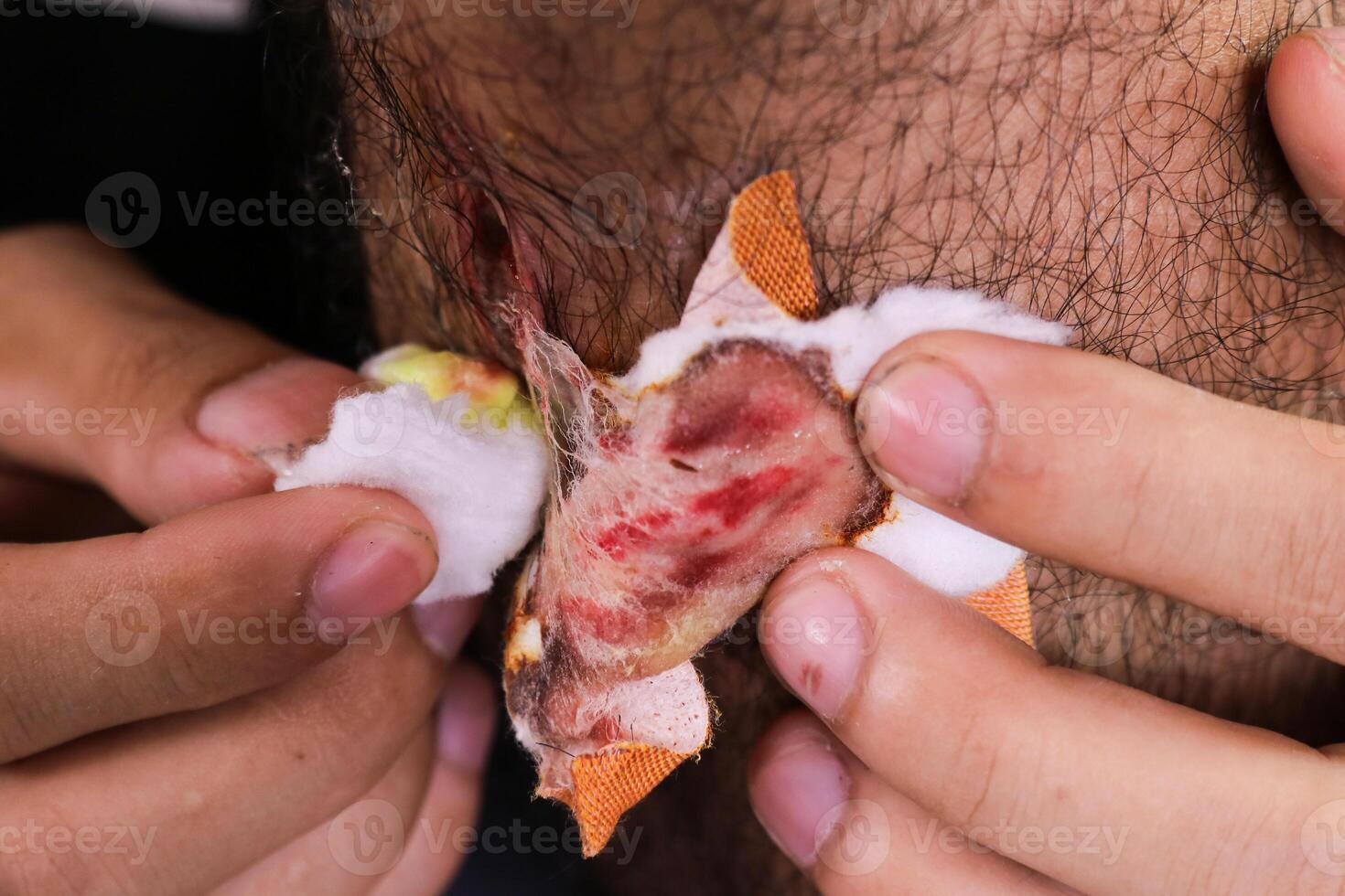 Close up of hands applying wound treatment to a man's ear using cotton swab and band aid. The skin is inflamed and painful. photo