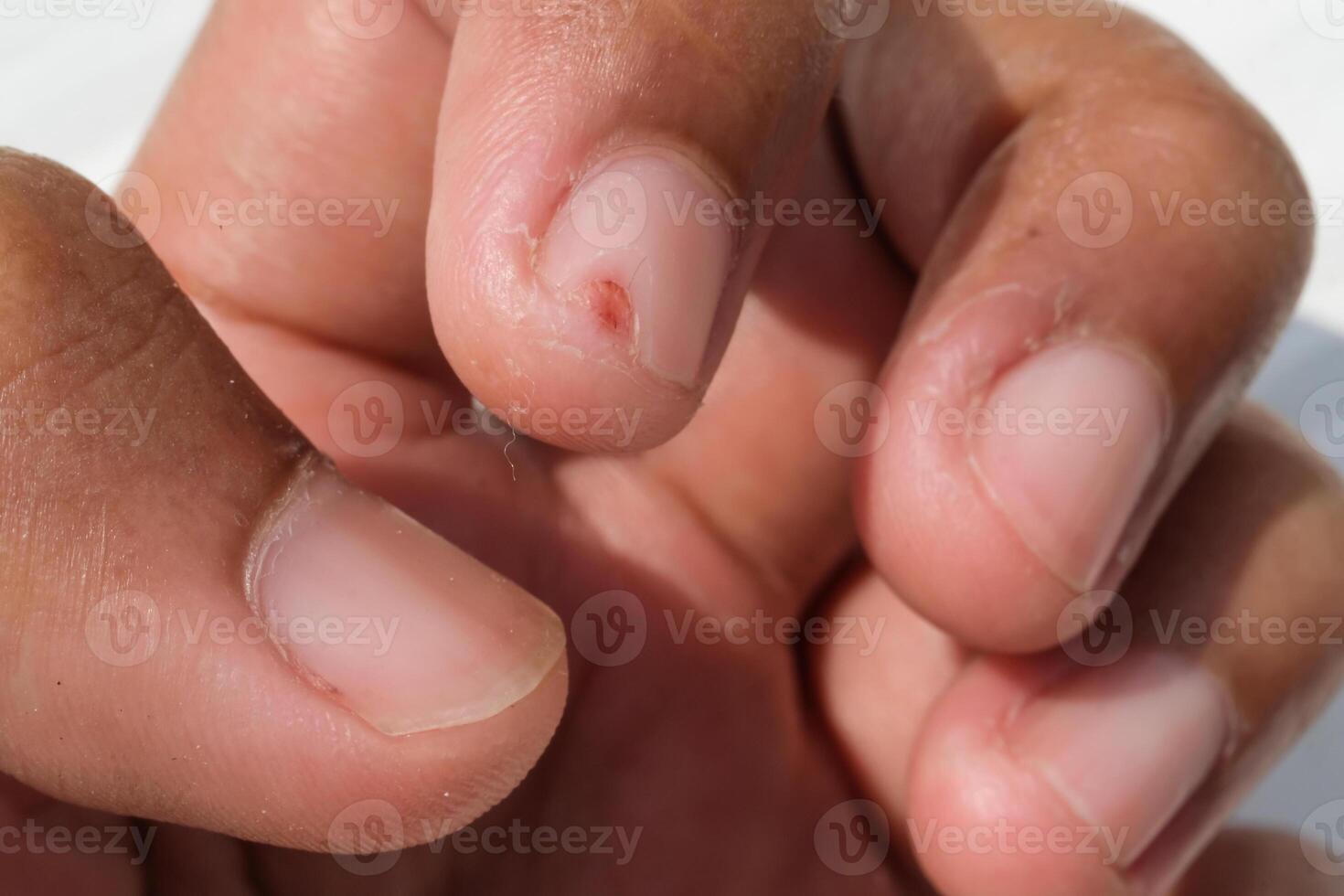 The index nail has an incised wound. Work accident in the kitchen which caused a finger injury. Closeup hand fingers. Macrophotography Concepts. Negative Space photo