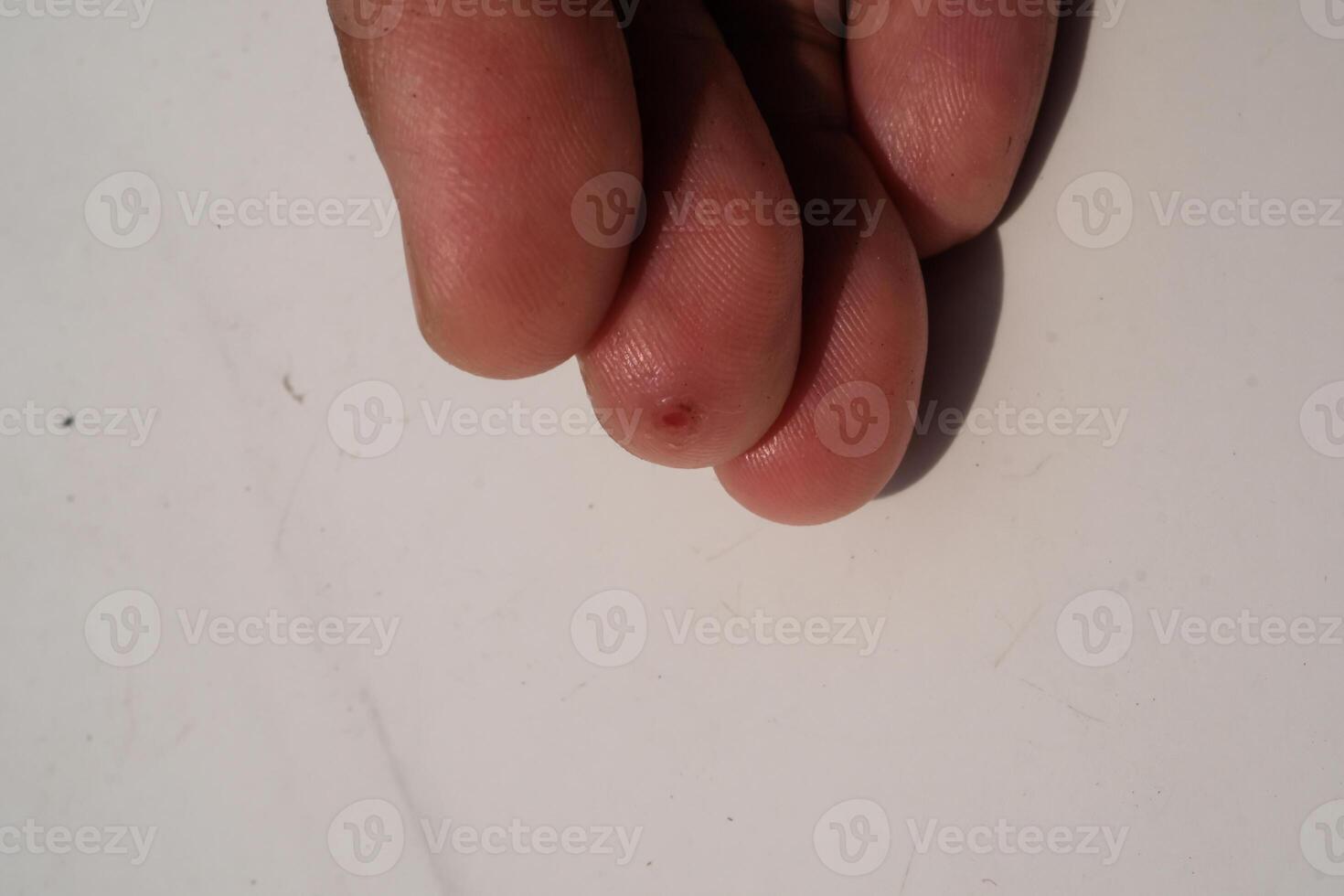 Injured middle finger skin. Wound on middle finger that started to heal after a few days. Health and medicine care. Human skin. Negative space. photo