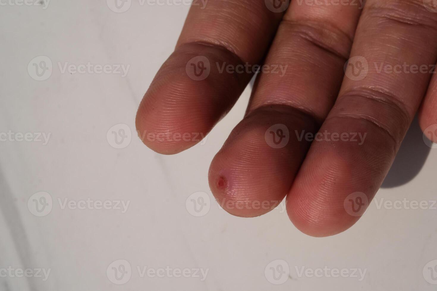 Injured middle finger skin. Wound on middle finger that started to heal after a few days. Health and medicine care. Human skin. Negative space. Isolated in white photo