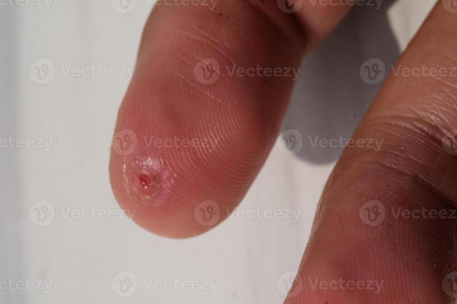 Closeup of injured middle finger skin. Wound on middle finger that started to heal after a few days. Health and medicine care. Human skin. Negative space. photo
