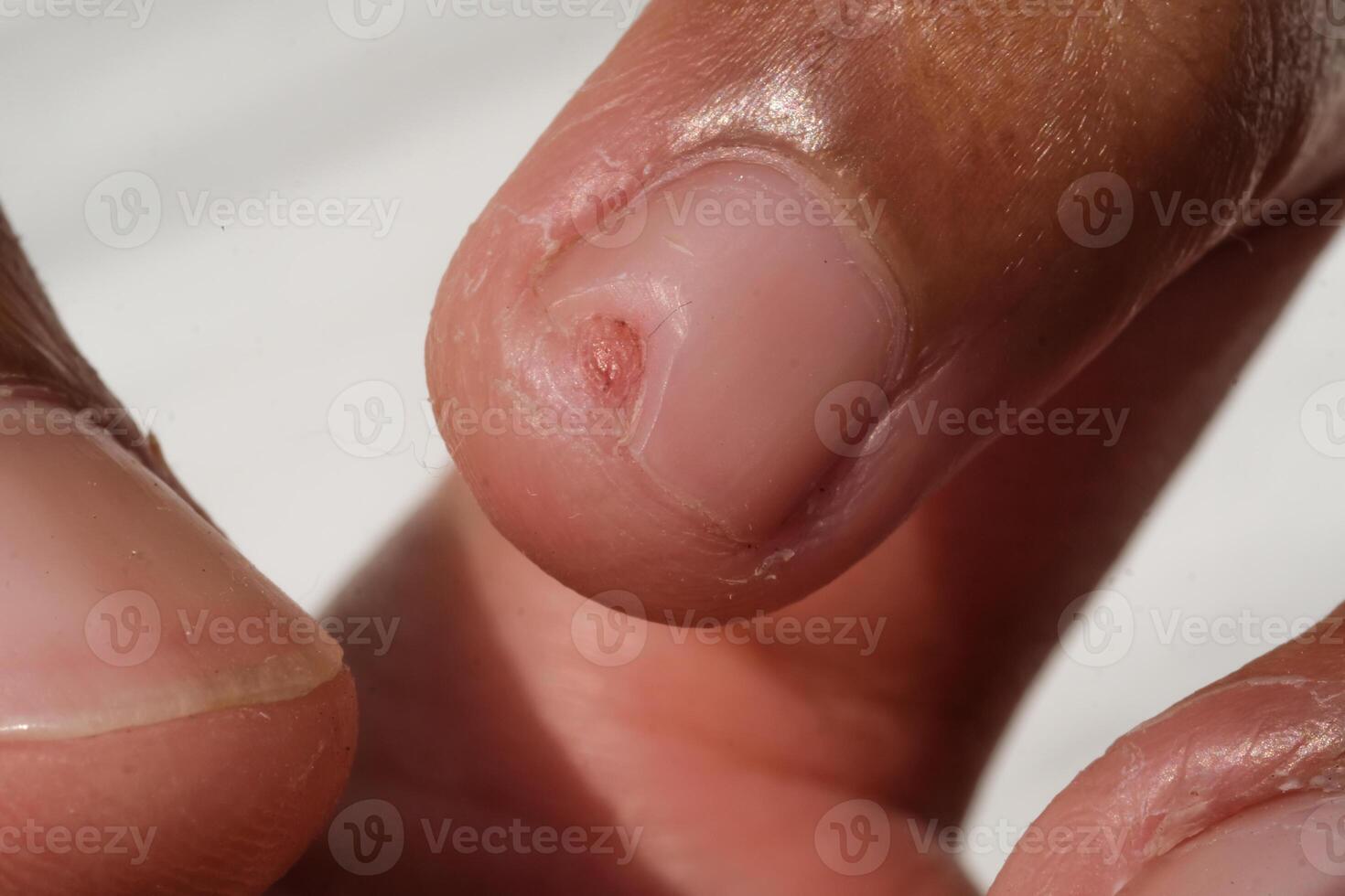 Finger nail has an incised wound. Work accident in the kitchen which caused a finger injury. Closeup hand fingers. Macrophotography Concepts. Negative Space photo