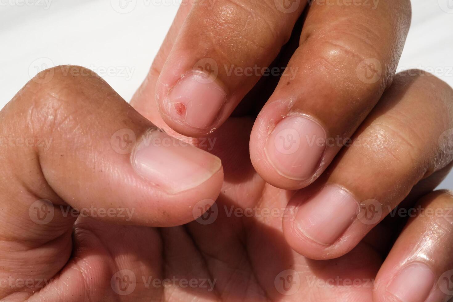 The index finger nail has an incised wound. Work accident in the kitchen which caused a finger injury. Closeup hand fingers. Macrophotography Concepts. Negative Space photo