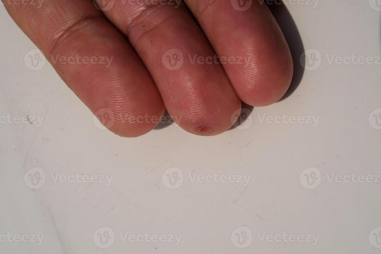 Closeup of injured middle finger skin. Wound on middle finger that started to heal after a few days. Health and medicine care. Human skin. Negative space. Isolated fingers photo