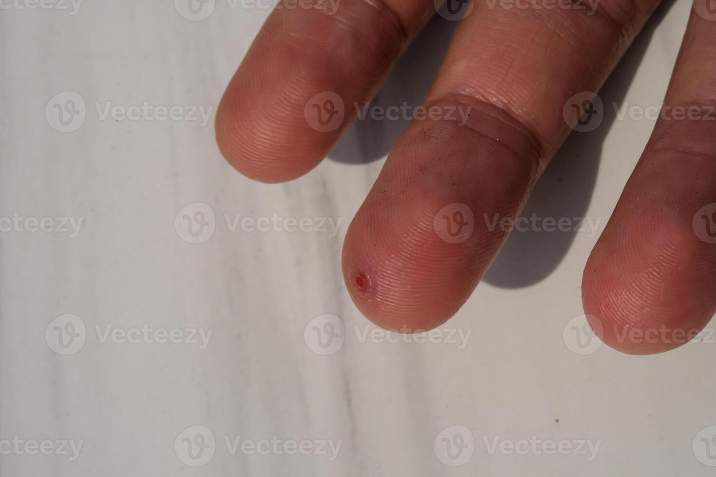 Isolated in white an injured middle finger skin. Wound on middle finger that started to heal after a few days. Health and medicine care. Human skin. Negative space. photo