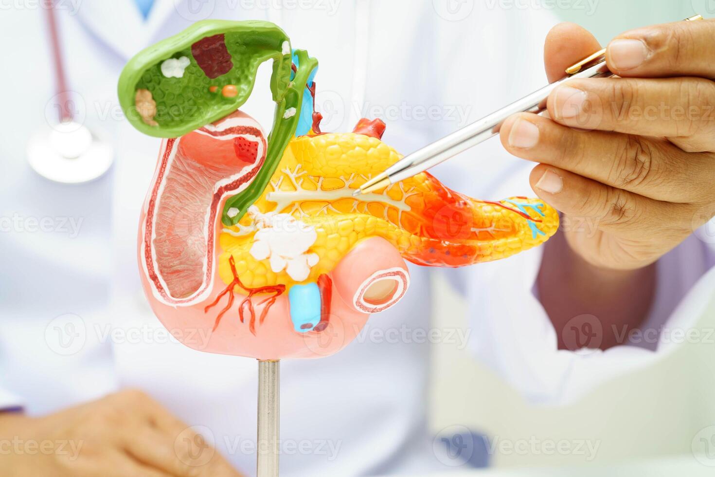 Pancreatitis, pancreatic cancer, Asian doctor with pancreas, gallbladder and bile duct human anatomy model at photo